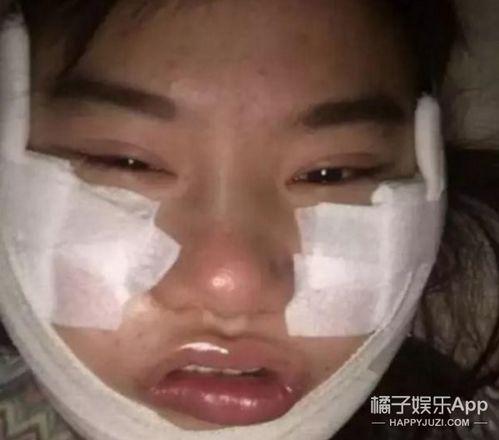 面部浮肿图片,面部浮肿成因解析与改善策略