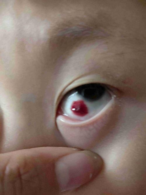 婴儿眼睛有红血丝图片,揭秘宝宝眼部健康小秘密