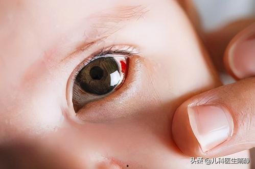 婴儿眼睛有红血丝图片,揭秘宝宝眼部健康小秘密