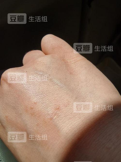 手上起小疙瘩图片,揭秘手上小疙瘩成因及应对策略