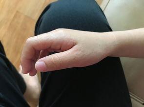 手上起小疙瘩图片,揭秘手上小疙瘩成因及应对策略